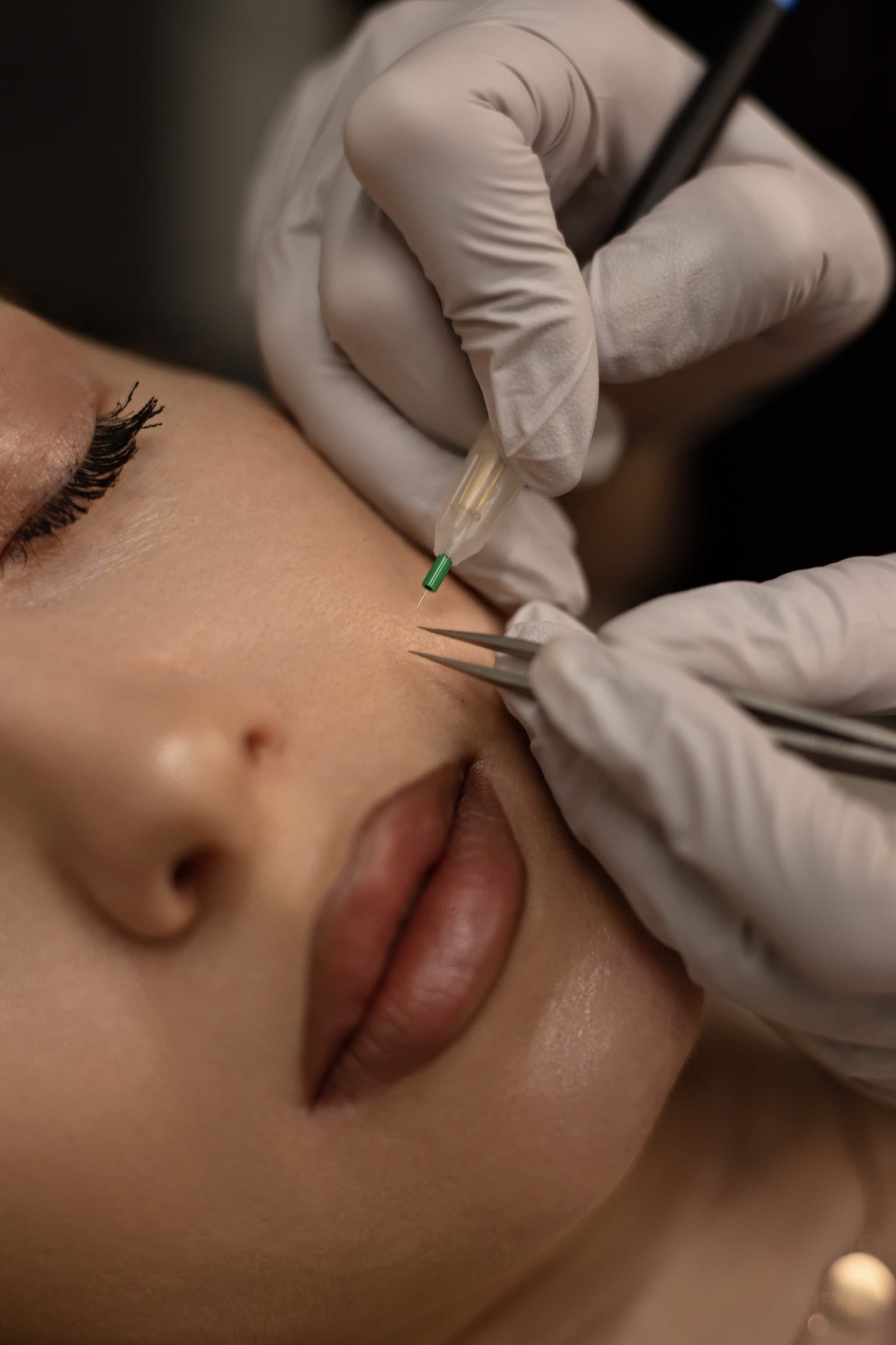 Upper lip precision treatment